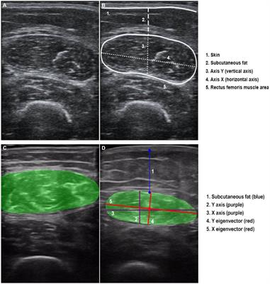 Body composition assessment with ultrasound muscle measurement: optimization through the use of semi-automated tools in colorectal cancer